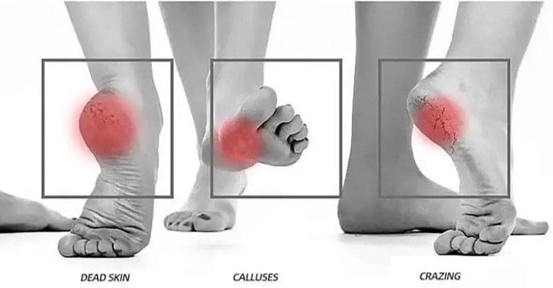 Foot Shape Foot Filer, Manual Callus Remover, Feet Heel Scraper, Shower Foot Scrubber Pedicure Tools