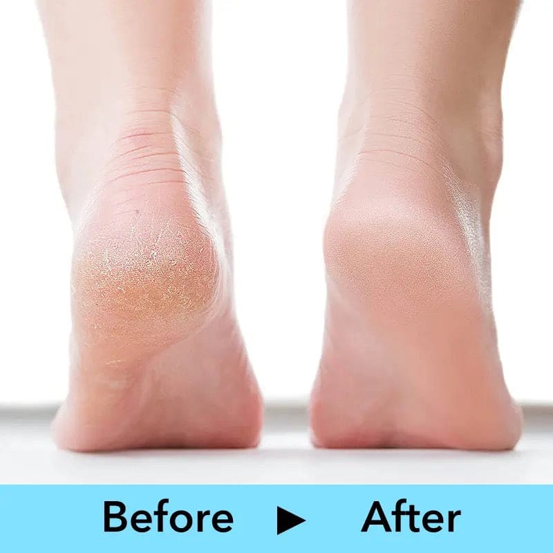 Double Sided Foot Filer, Professional Pedicure Foot Filer, Stainless Steel Foot Scrubber, Hard Skin Removers, Callus Dead Skin Remover, Anti-slip Plastic Handle Pedicure Tool, Stainless Steel Dead Skin Scrapper
