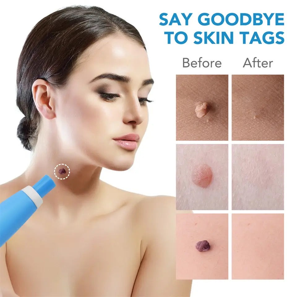Skin Tag Remover, 2 In1 Painless Auto Skin Tag Remover, Mole Wart Removal Kit, Micro Skin Tag Remover