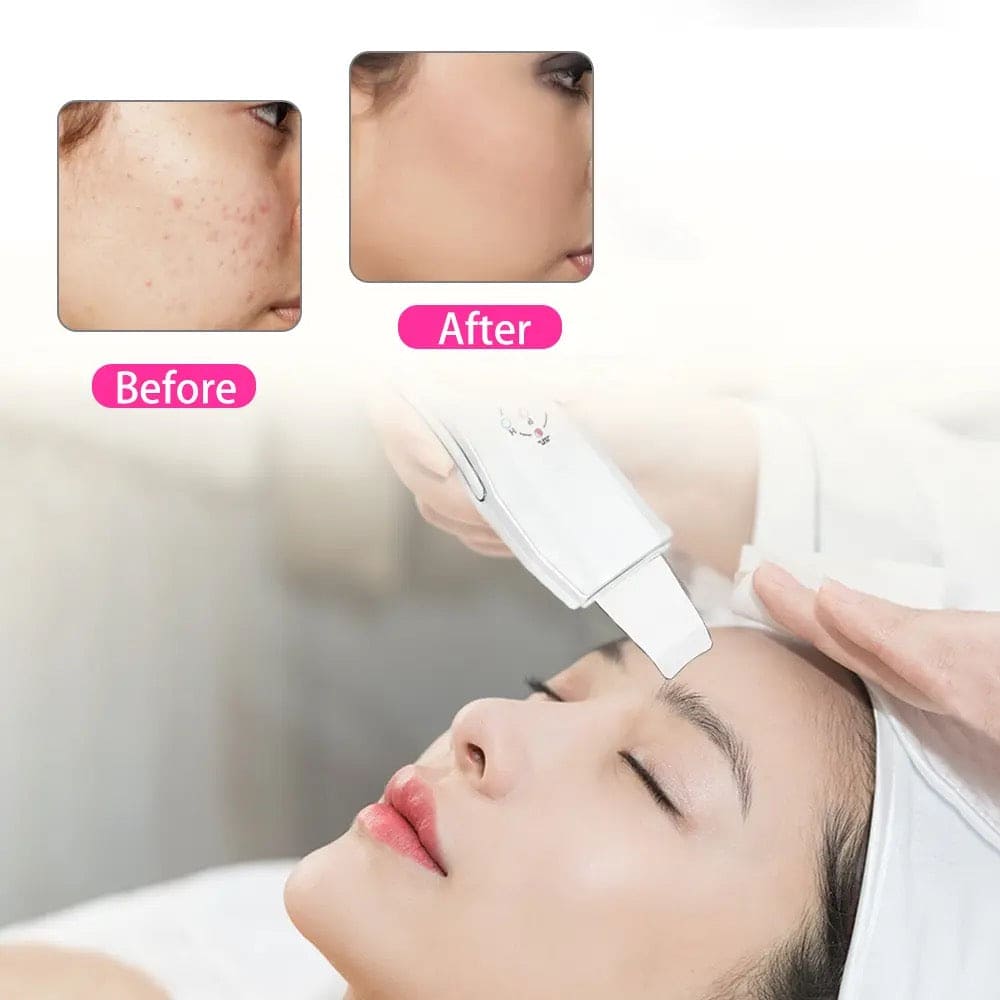 Ultrasonic Skin Scrubber, Cavitation Vibration Peeling Massager, Acne Blackhead Remover, Deep Clean Beauty Instrument Device, Acne Exfoliating Peeling Spatula,  Deep Face Cleaning Pore Cleaner Tool,  Exfoliation Grease Blackhead Extractor Lifting Device